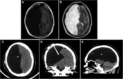 Ventriculoperitoneal shunt for giant porencephaly: a case report and literature review